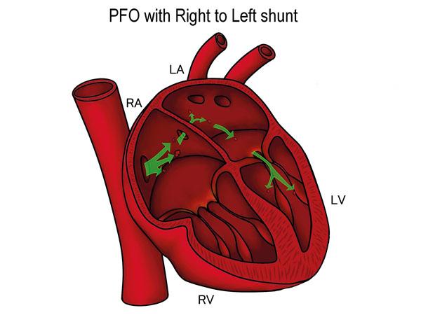 Thumbnail photo for The heart and Patent Foramen Ovale (PFO) 