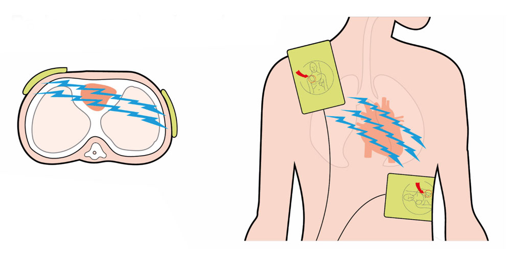 pad placement