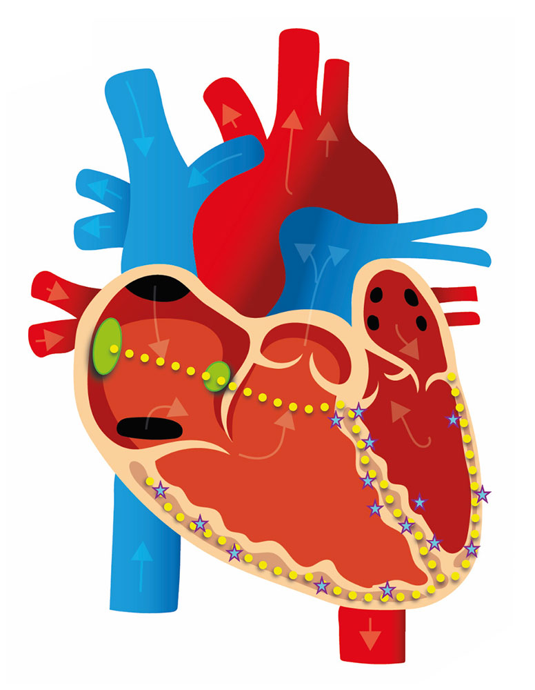 ventricular fibrillation
