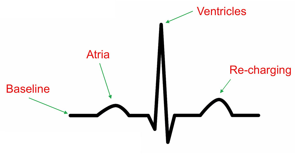 normal rhythm