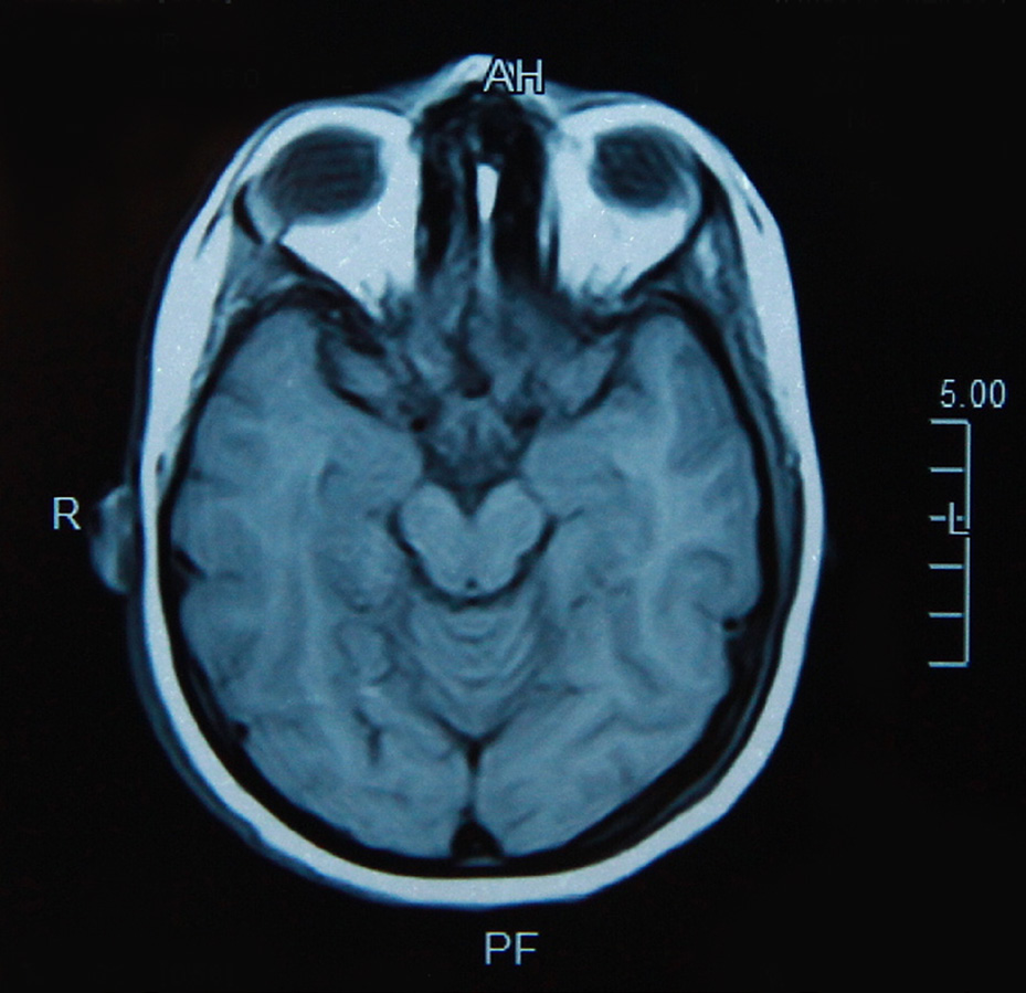 topdown view of MRI brain scan