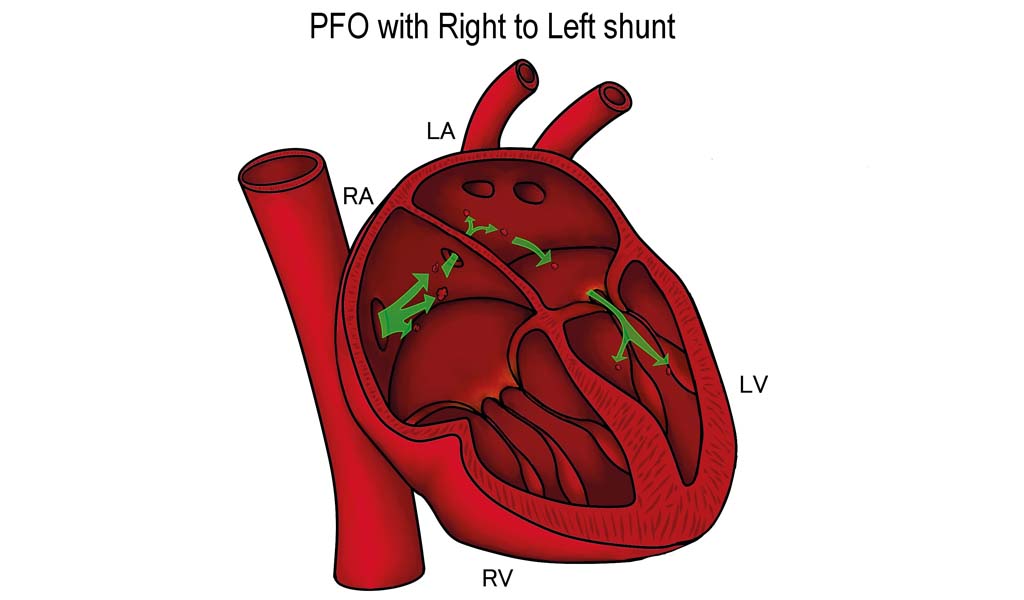 The heart and Patent Foramen Ovale (PFO) Anatomy of a diver British